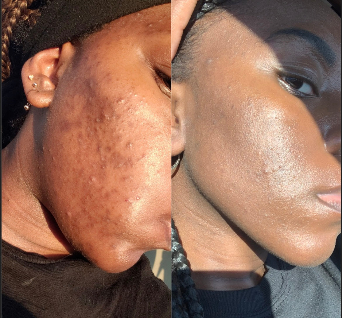 Hyperpigmentation + Dark Spot Correcting Kit