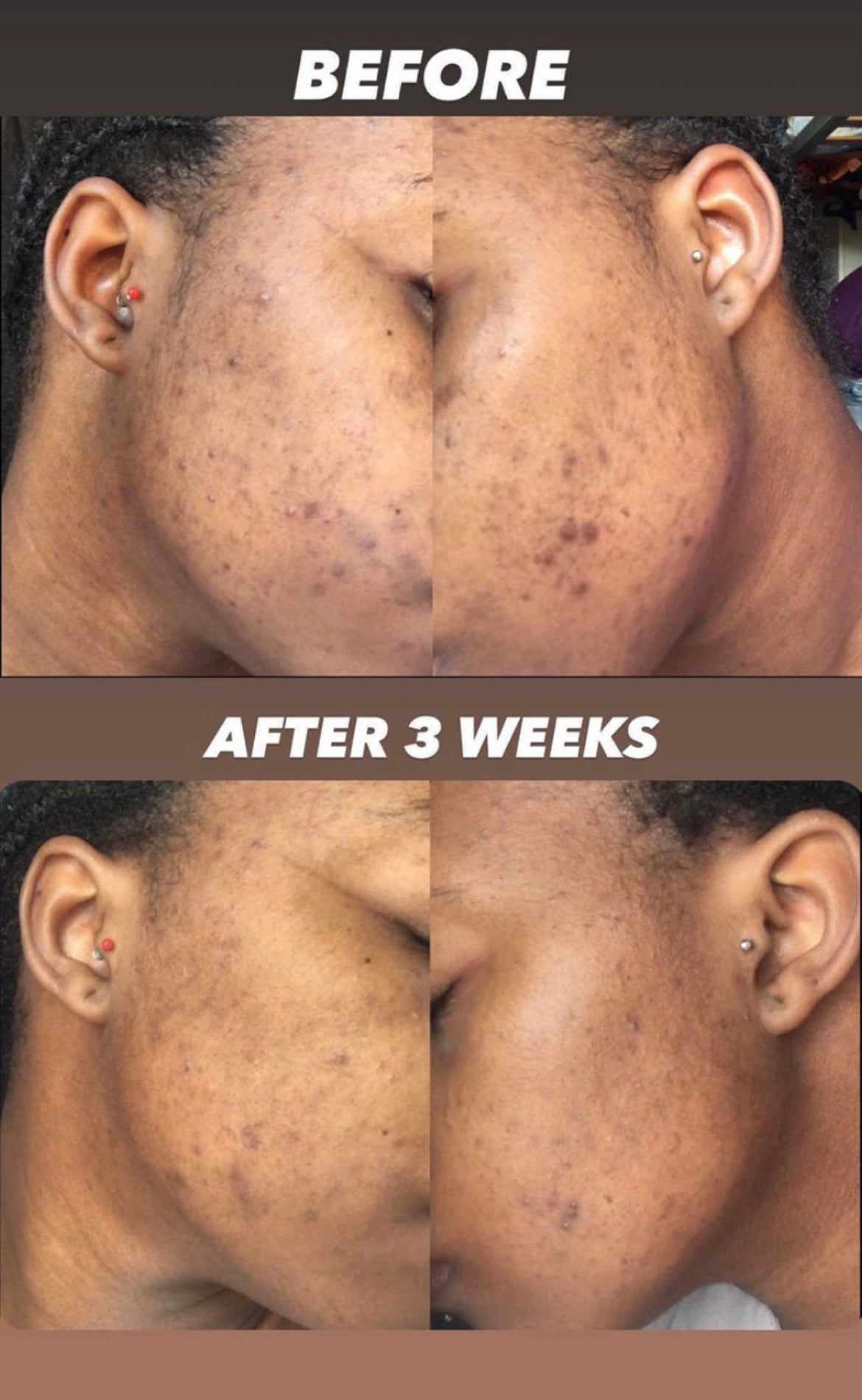 Hyperpigmentation + Dark Spot Correcting Kit