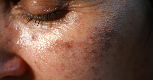 Are Hyperpigmentation and Dark Spots the Same?